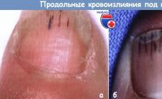 Blod under nageln (hematom under nageln) - vad man ska göra, hur man blir av med det Behandling av hematom under tånageln