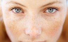 Manchas de pigmento debajo de los ojos: causas con fotos y cómo deshacerse de ellas.