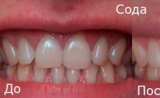 Vilka hemmetoder hjälper till att bleka tänderna snabbt?