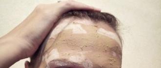 foto av resultatet och kärleksförklaring till lera efter två månaders regelbunden användning från ägaren av fet hud