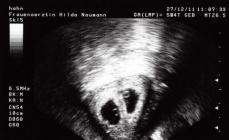 ¿Qué indican los signos sobre el embarazo temprano con gemelos?