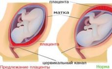 Baja placenta previa durante el embarazo Las razones pueden ser diferentes, pero las principales son
