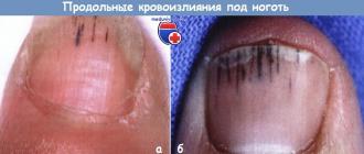 Blod under nageln (hematom under nageln) - vad man ska göra, hur man blir av med det Behandling av hematom under tånageln